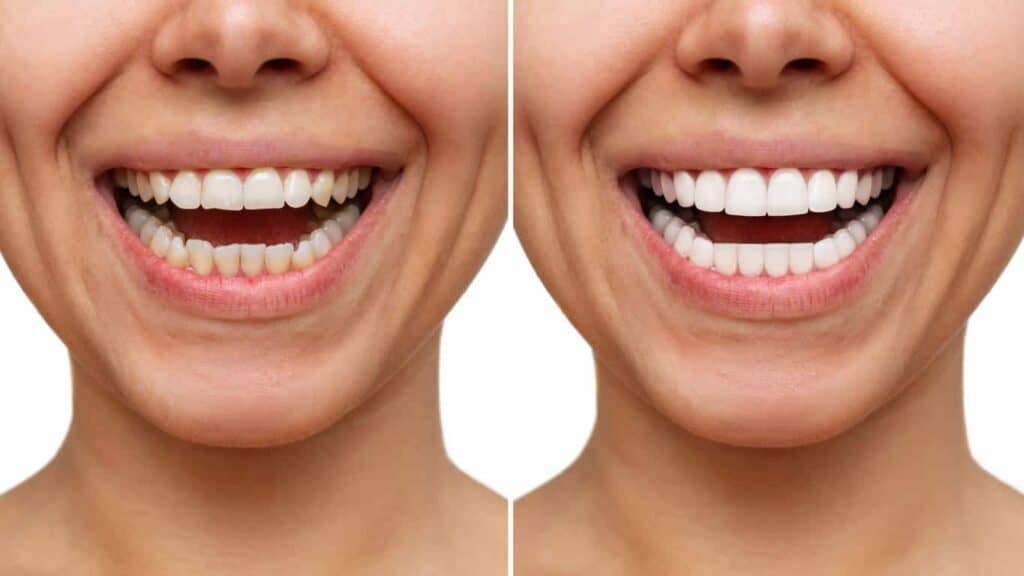 Contact Aspire White for teeth whitening services – Get in touch with Basildon today
