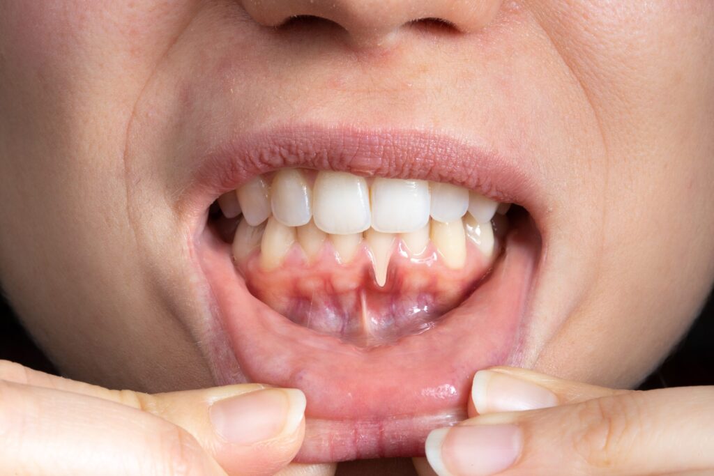 Preparing for teeth whitening with receding gums Basildon