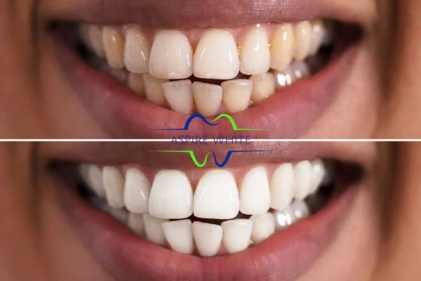 Aspire White customer before and after Basildon results.