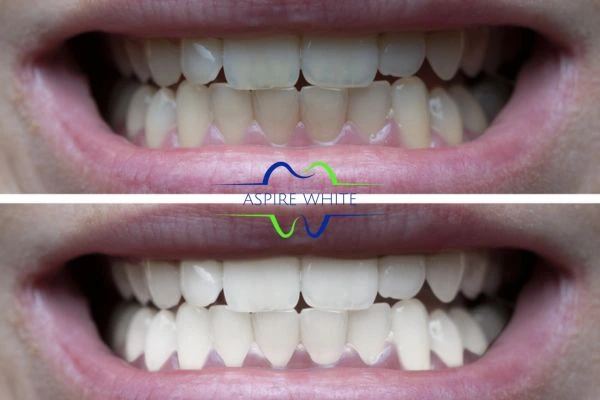 1 hour laser teeth whitening before and after results Basildon