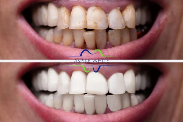Before and after results of laser teeth whitening Basildon Book in online today!