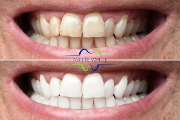Achieve a radiant smile with professional laser teeth whitening Basildon